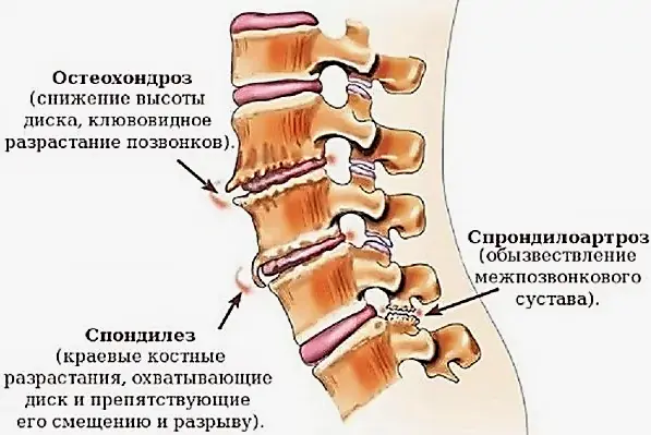 протрузия