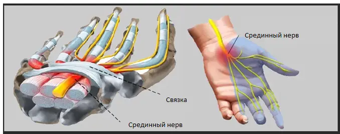 протрузия